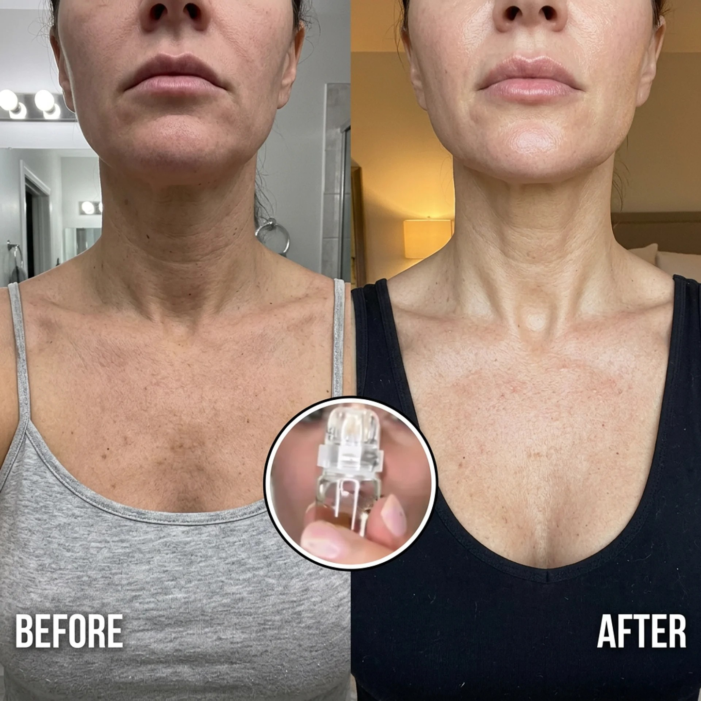 SkinRenew Micro Needle Facial Kit