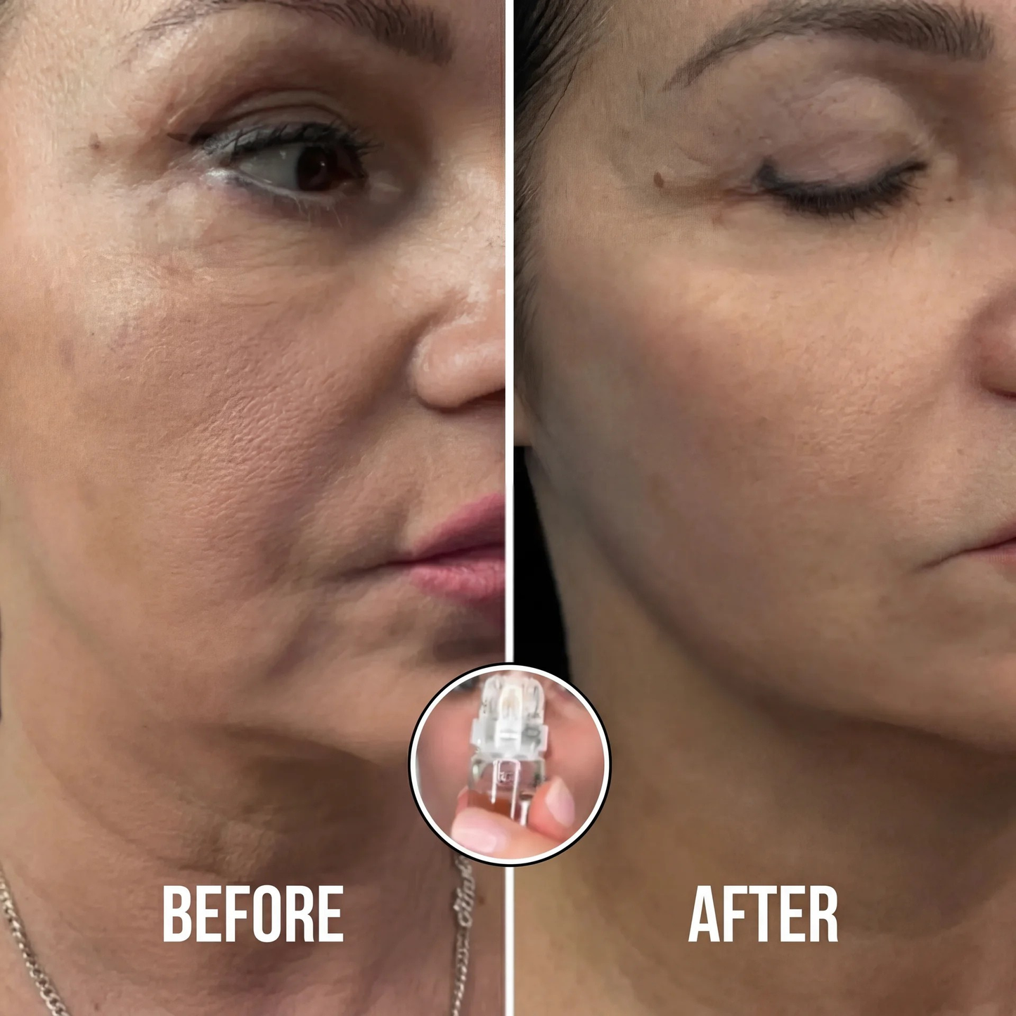SkinRenew Micro Needle Facial Kit
