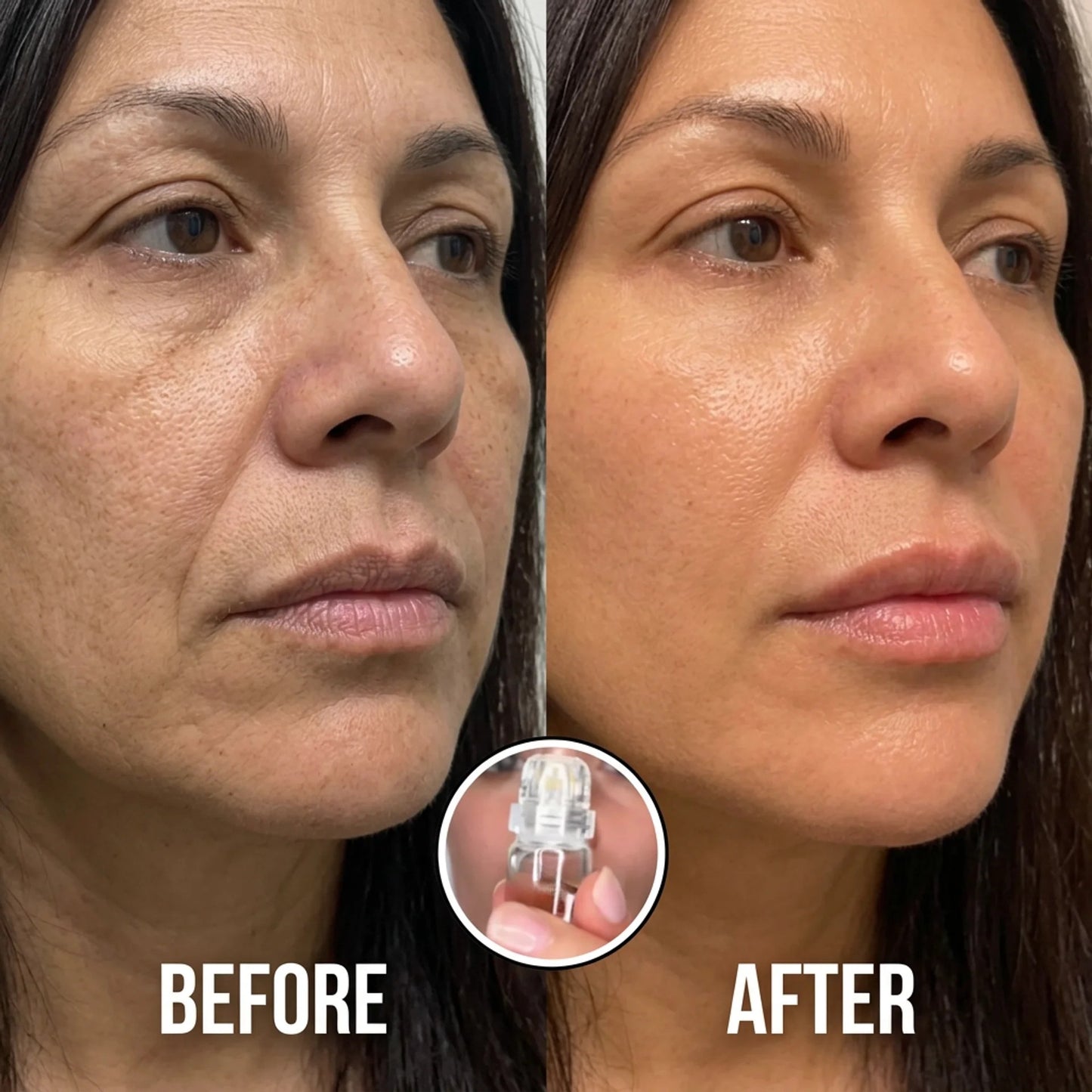 SkinRenew Micro Needle Facial Kit