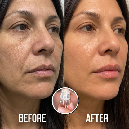 SkinRenew Micro Needle Facial Kit