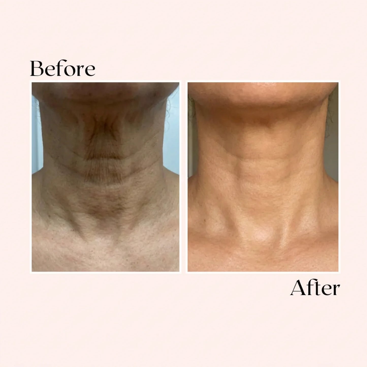 SkinRenew Micro Needle Facial Kit